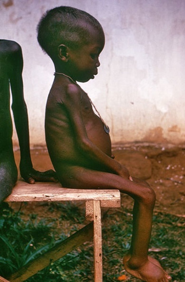 Hungertod in Biafra Hungertod in Biafra