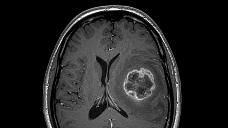 Hirntumor Hirntumor